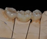 zirconia-prettau-colorato-1