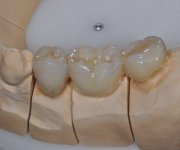 Zirconia Prettau colorato